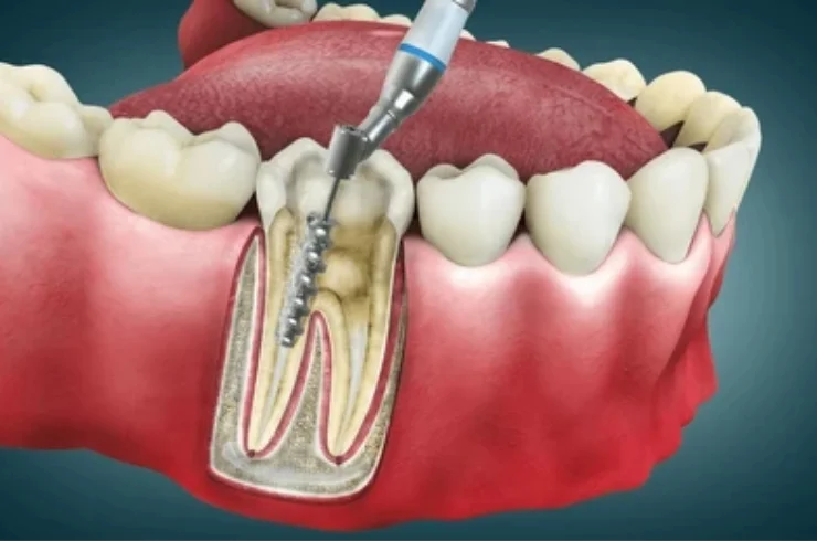 Root Canal Treatment------9
